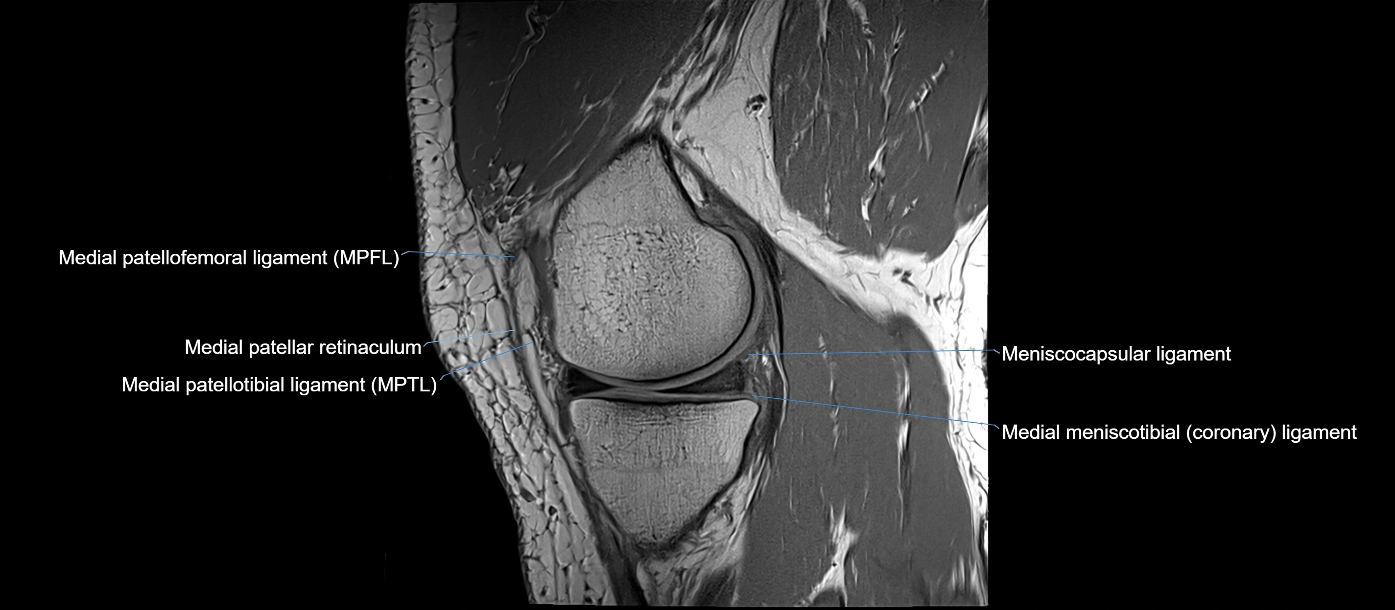 MRI sagittal  ligaments cross sectional anatomy 3T  radiology  image-img-00001-00015.webp